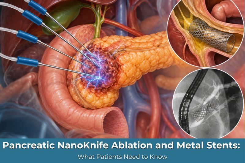 Pancreatic NanoKnife Ablation and Metal Stents: What Patients Need to Know